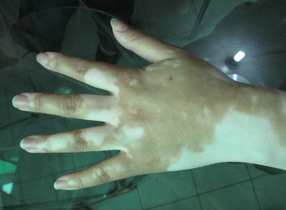 大人该怎么预防白癜风?(图1) 大人怎么预防白癜风