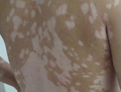 身体的哪个部位易发生白癜风?(图1) 身体的哪个部位易发生白癜风