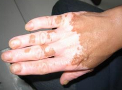 白癜风如果不及时治疗会有什么后果