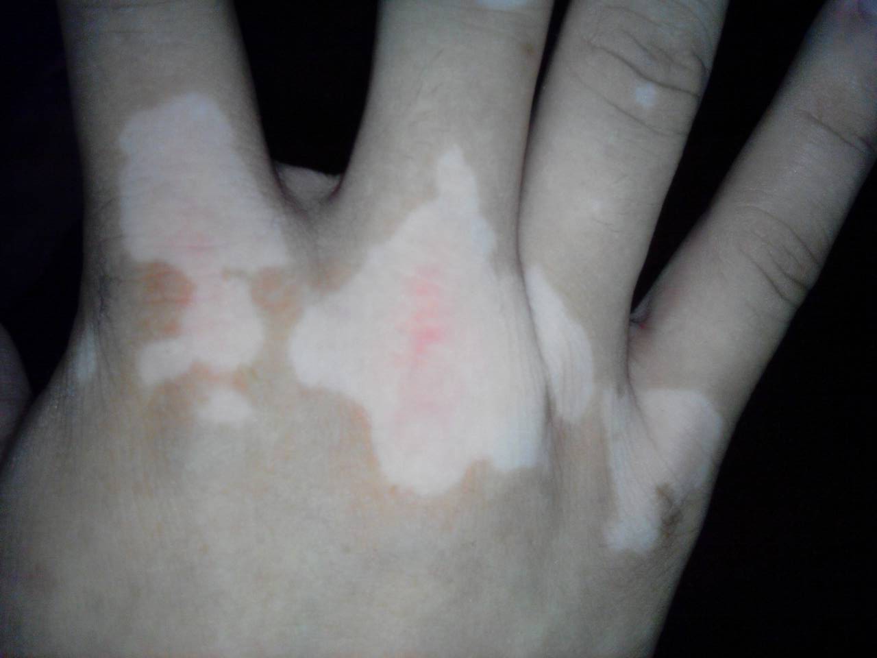 怎么预防节段型白癜风