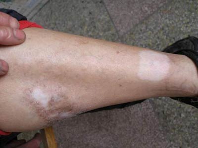 关于白癜风症状的一些基本知识(图1) 白癜风基本常识