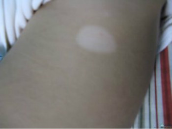 白癜风不同阶段的表现是什么样的呢?(图1) 白癜风不同阶段的表现是什么样的呢?(图1)