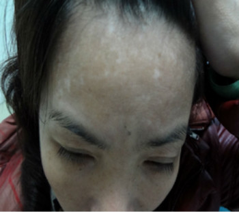 得了白癜风为什么会红肿痒呢?(图1) 得了白癜风为什么会红肿痒呢?(图1)