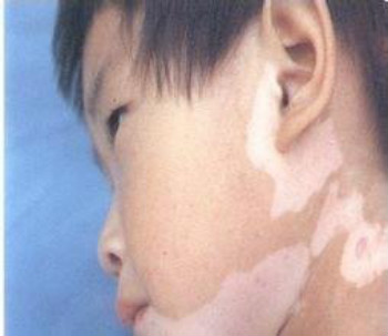 儿童该怎么预防白癜风?(图1) 儿童该怎么预防白癜风?(图1)