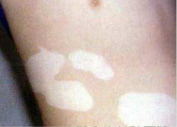 减少紫外线照射对白癜风预防有帮助么?(图1) 减少紫外线照射对白癜风预防有帮助么?(图1)