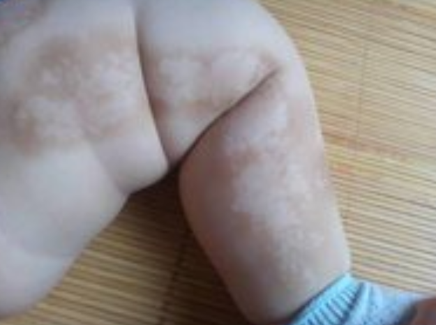 怎样阻止白癜风复发?(图1) 怎样阻止白癜风复发