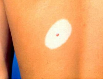 发生白癜风的原因是什么