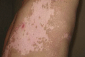 白癜风发作是什么原因