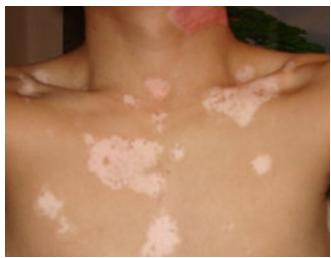 节段型白癜风有哪些治疗方法