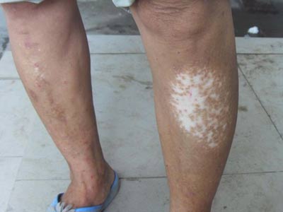 如何判断是否得了白癜风