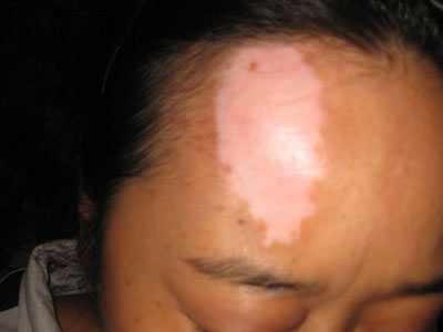 预防白癜风扩散该怎么做