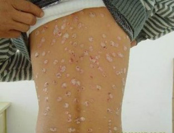 白癜风的诱发因素是什么?(图1) 白癜风的诱发因素是什么?(图1)