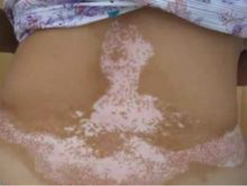 背部白癜风怎么治疗效果好?(图1) 背部白癜风怎么治疗效果好?(图1)