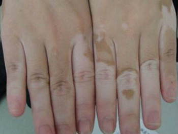 节段型白癜风如何进行治疗?(图1)