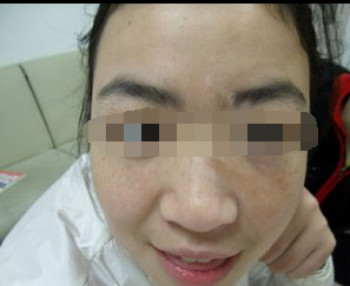 女性患了白癜风怎样治疗?(图1)