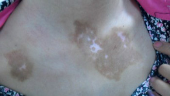 怎样防止白癜风的发病?(图1)