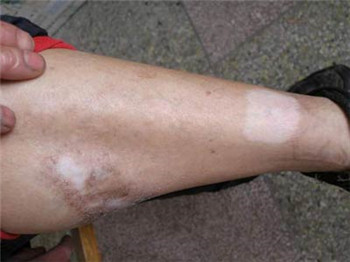 女性患有白癜风怎样治疗?(图1) 女性患了白癜风怎样治疗