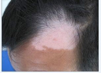 白癜风是由什么原因引起的?(图1) 白癜风是由什么原因引起的?(图1)