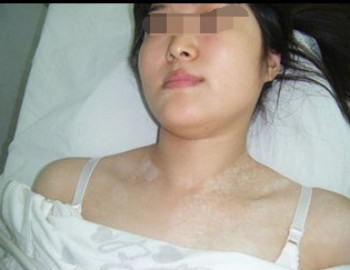 女性患了白癜风应该怎样治疗?(图1) 女性患了白癜风应该怎样治疗?(图1)