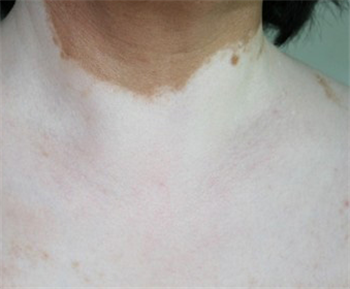 白癜风患者的早期症状有哪些