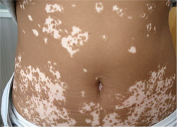 白癜风患者有哪些禁忌?(图1) 白癜风患者有哪些禁忌