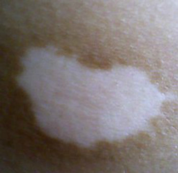 白癜风病人有什么禁忌吗(图1) 白癜风病人有什么禁忌吗(图1)