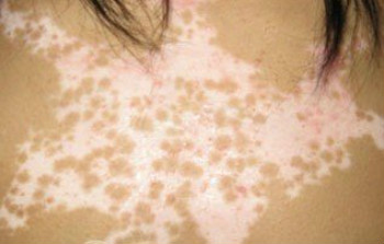 白癜风泛发型有哪些症状特点?(图1) 白癜风泛发型有哪些症状特点?(图1)