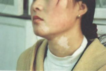 白癜风患者可以给孩子喂母乳吗?(图1) 白癜风患者可以给孩子喂母乳吗?(图1)