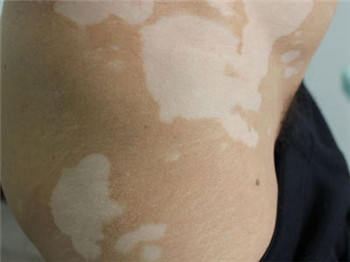 治疗白癜风花钱多吗?(图1) 治疗白癜风花钱多吗