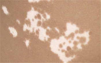 白癜风患者应该禁忌一些什么?(图1) 白癜风患者应该禁忌一些什么