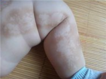 白癜风的高发群体包括什么人呢