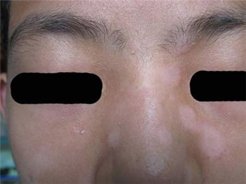 偏方治疗白癜风管用吗?(图1)