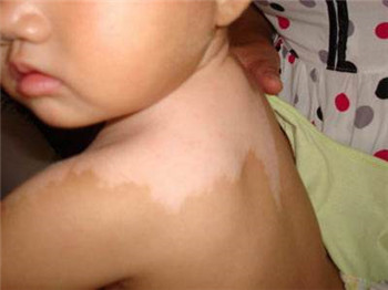 小孩得了白癜风有哪些症状