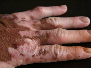 白癜风预防哪些办法好