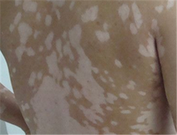 哪些运动可以辅助治疗白癜风