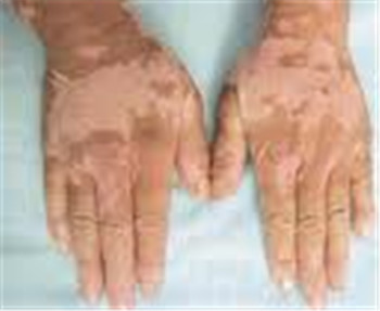 白癜风是不是传染病呢?(图1)