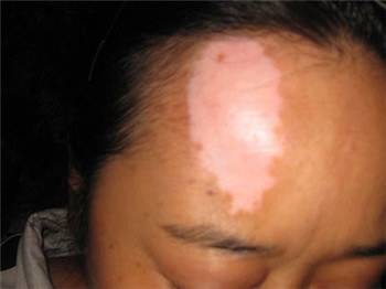 女性白癜风病发怎样治疗?(图1)