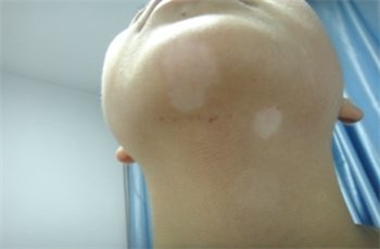 得了白癜风有哪些方面需要注意