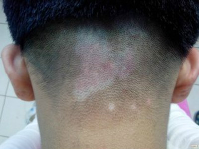 白癜风得病的原因究竟是什么？(图1)