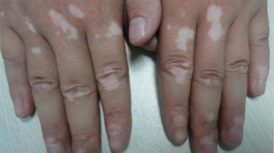 白癜风会不会是传染病？(图1)