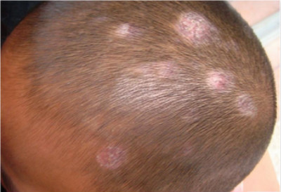 究竟小孩患白癜风是什么因素造成？(图1)