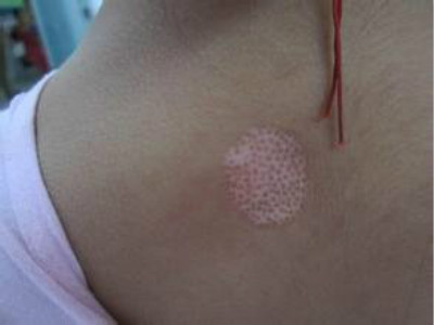 如果出现白癜风症状该怎么办?(图1)