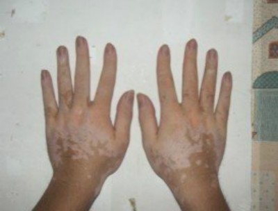 预防白癜风的措施有哪些?(图1)