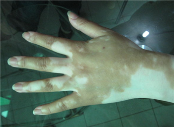 科学治疗白癜风有哪些方法