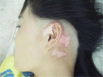女性白癜风如何治疗呢