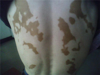 白癜风的诱发因素有什么