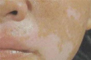 得了白癜风后患处发红发痒是怎么回事?(图1) 得了白癜风后患处发红发痒是怎么回事
