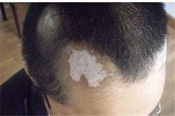 治疗白癜风为什么一直好不了?(图1) 治疗白癜风为什么一直好不了