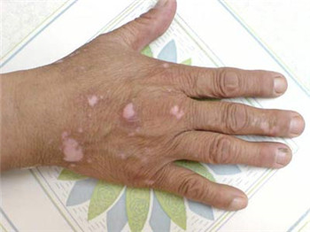 老年白癜风的原因有什么?(图1)