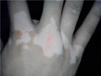 怎么白预防癜风效果比较好？(图1)